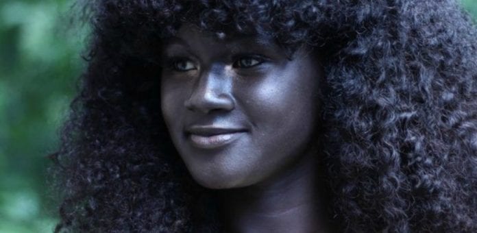 9 beautiful people who are unique for their skin color