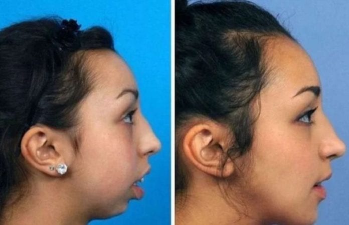 She went into a jaw and teeth surgery. Now she looks like a completely different person