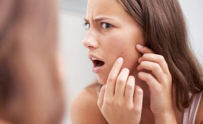 Things that can help you fight acne