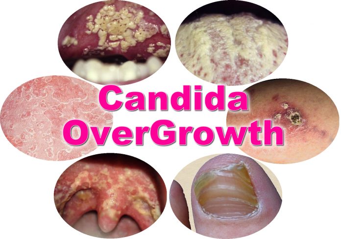 What Should You Know About Candida Overgrowth