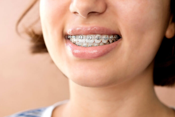 Comprehensive Advantages of Braces