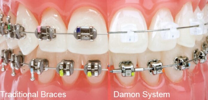 Damon braces vs traditional braces