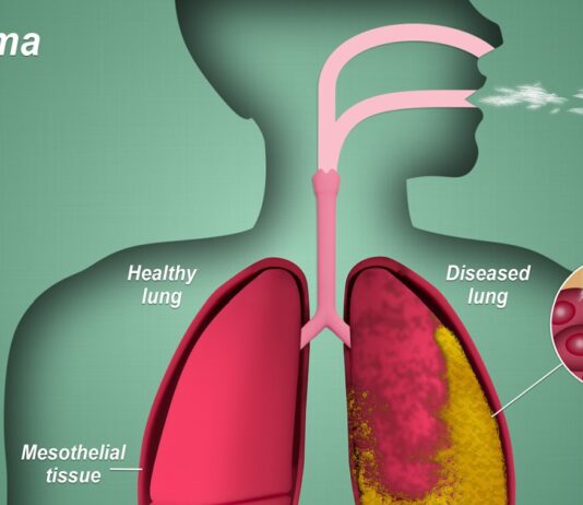 Mesothelioma Symptoms