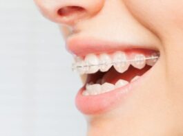 Teeth Straightening Techniques