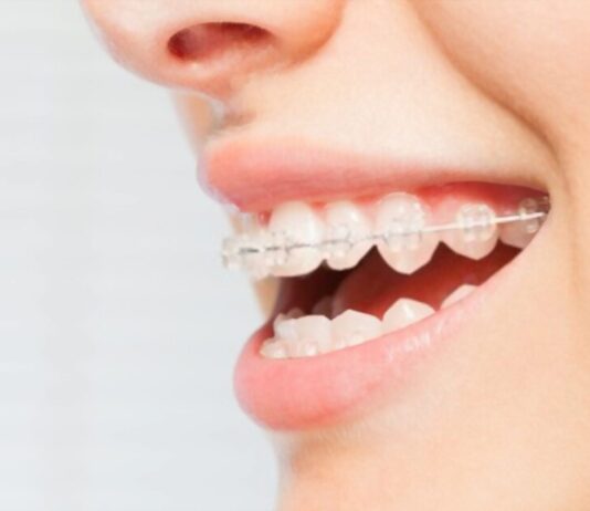 Teeth Straightening Techniques