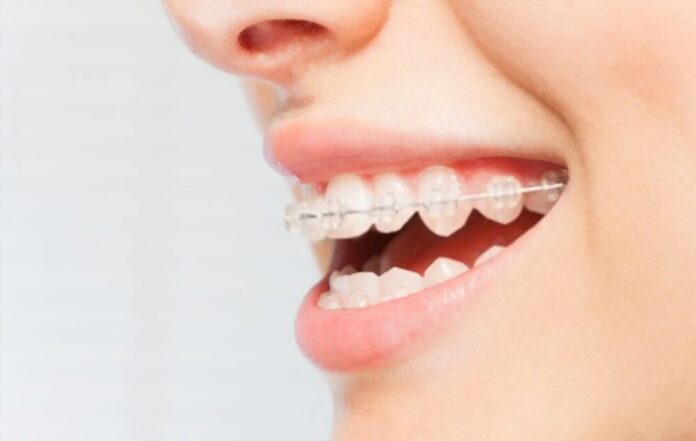 Teeth Straightening Techniques