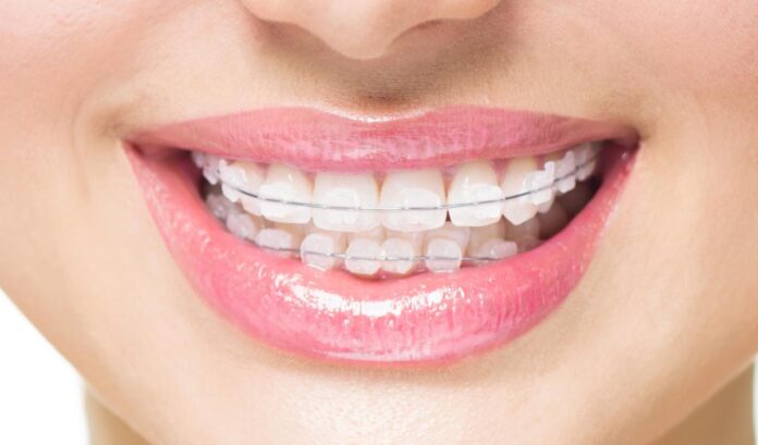 teeth straightening options