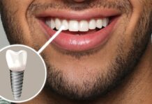 Discover the Benefits of Implant Dentistry for a Confident Smile