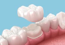 Why Dental Crown Services in Las Vegas Are a Big Deal