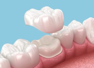 Why Dental Crown Services in Las Vegas Are a Big Deal