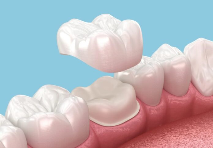 Dental Crown